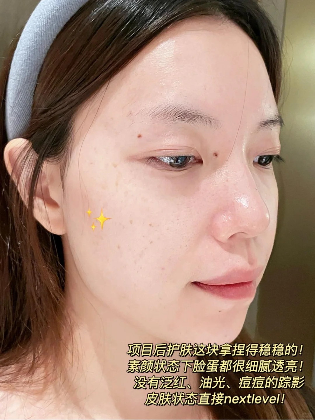 油痘肌做完项目后的早晚护肤流程分享！_8_奶白星冰乐_来自小红书网页版.jpg